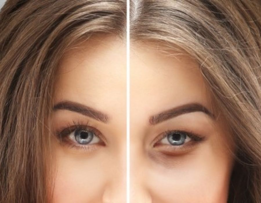 Blefaroplastika