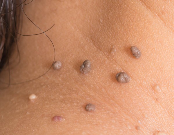 kožna znamenja ali kožni izrastki na vratu ženske diagnostika clarus