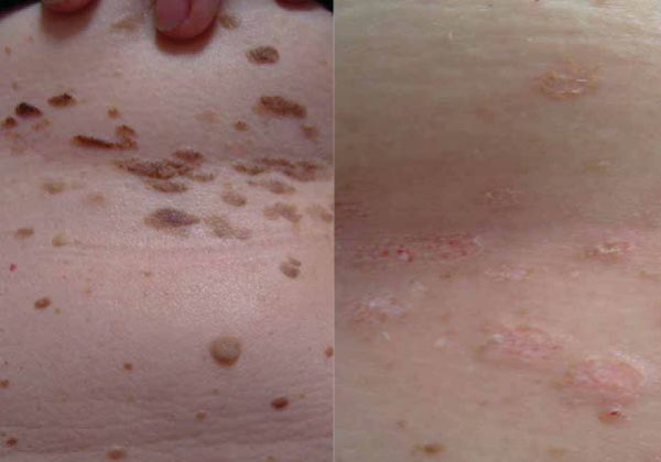 Odstranitev veliko kožnih znamenj iz telesa. Slike prej in potem.
