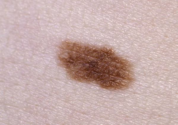 Kožna znamenja ki so večja od 6 milimetrov so lahko znak kožnega raka.