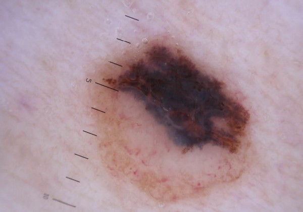 Kožna znamenja - kdaj je potrebno opraviti dermatološki pregled 