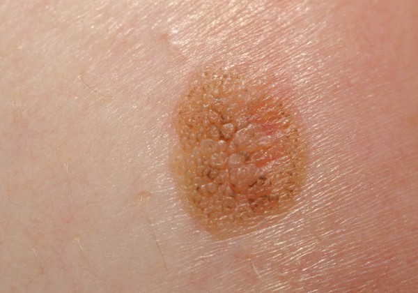 Kožno znamenje ima nejasen rob - kar lahko nakazuje na vrsto kožnega raka
