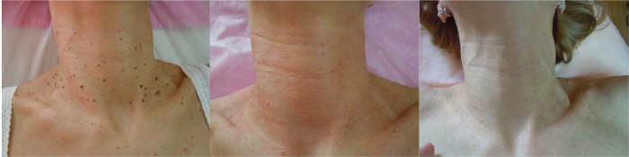 Odstranitev velikega števila kožnih znamenj na vratu, slike prej in potem. 