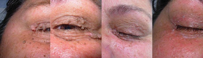 Odstranjevanje kožnih znamenj in izrastkov na veki očesa. Slike prej in potem. 