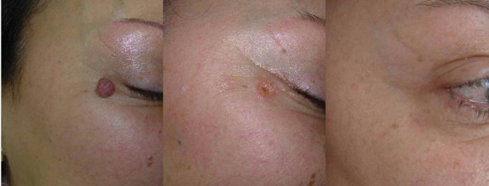 Odstranitev velikega kožnega znamenja na obrazu prej in potem. 