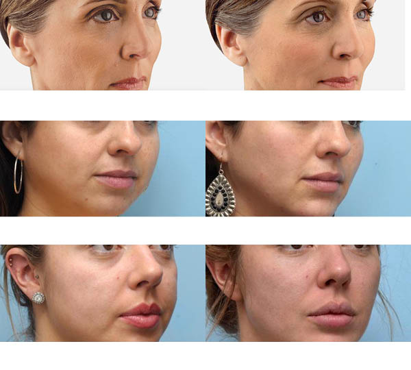 Primer preoblikovanja in povečanja lic oz. dodajanja volumna v lica z injiciranjem dermalnih polnil (filerjev) s hialuronsko kislino v kožo.