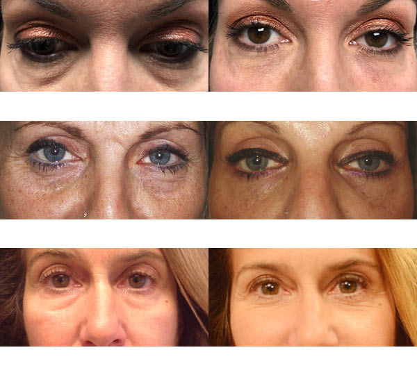 Zapolnitev očesnih vdolbin (podočnjakov) z injiciranjem dermalnega polnila s hialuronsko kislino - slike prej in potem.