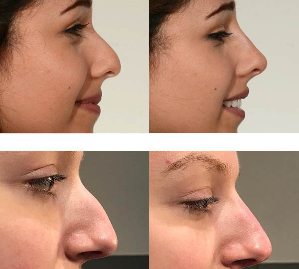 Oblikovanje nosu oz. izravnava nosne grbe z injiciranjem dermalnega polnila s hialuronsko kislino slike prej in potem.