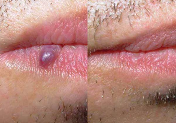 kožna znamenja - odstranjevanje na ustnici prej in potem. 
