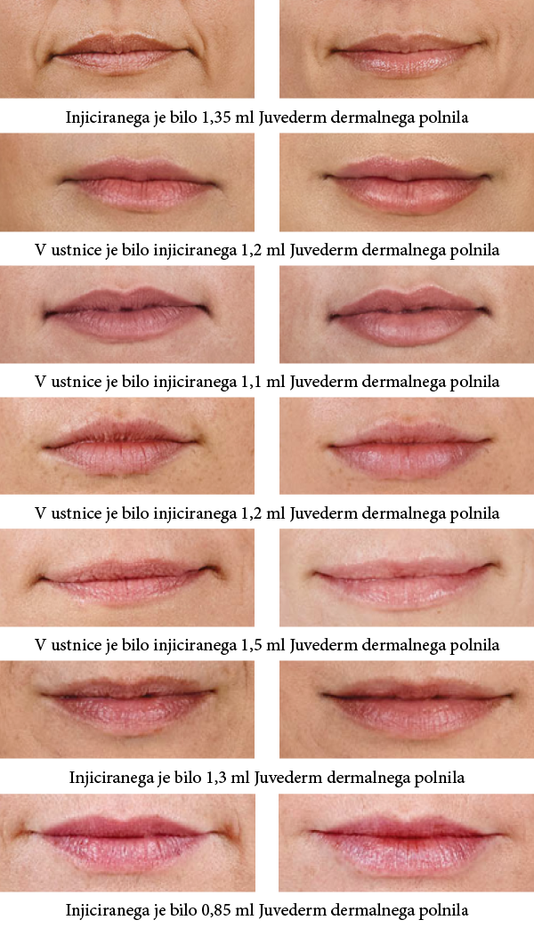 Povečanje in preoblikovanje ustnic z injiciranjem dermalnega polnila s hialuronsko kislino slike prej in potem.